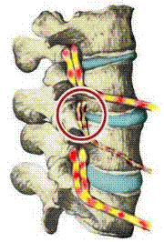 Animated illustration showing how a vertebral subluxation compresses spinal nerves